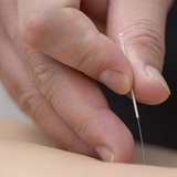 طب سوزنی